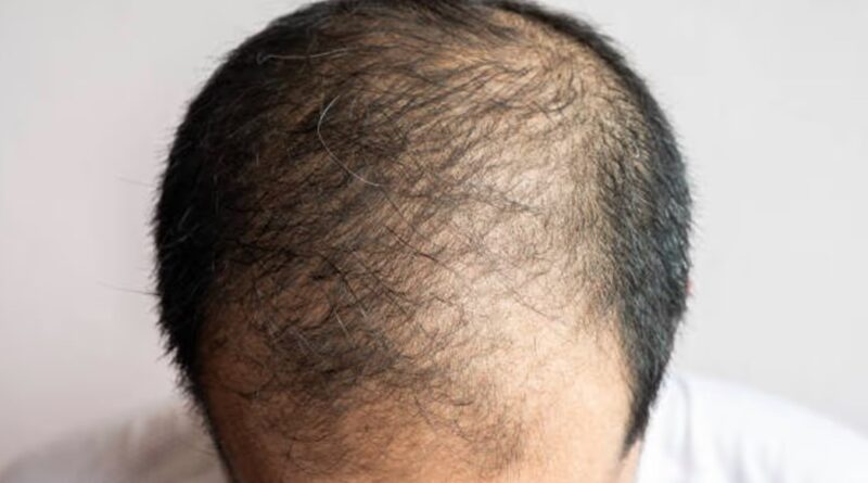 क्या सच में हेलमेट पहनने से झड़ते हैं बाल? जानिए हकीकत